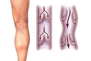 utflöde av blod i åderbråck vid olika stadier av sjukdomsutvecklingen